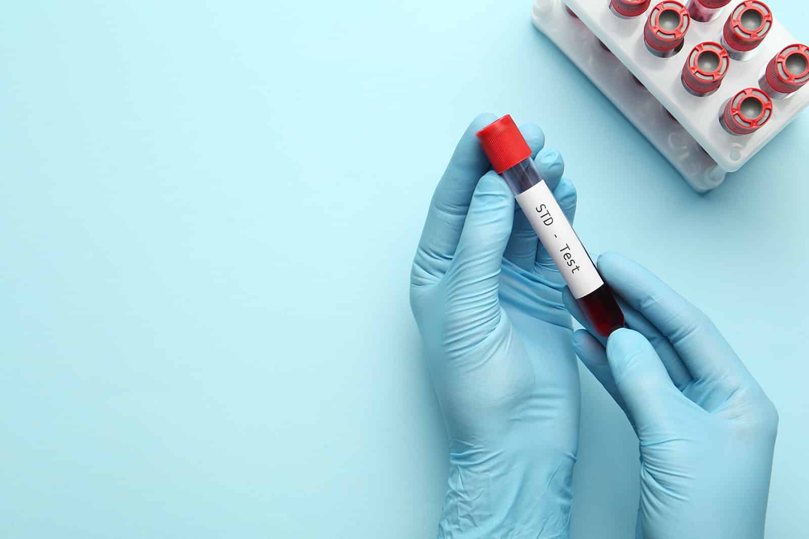 Do Normal Blood Tests Show STDs?